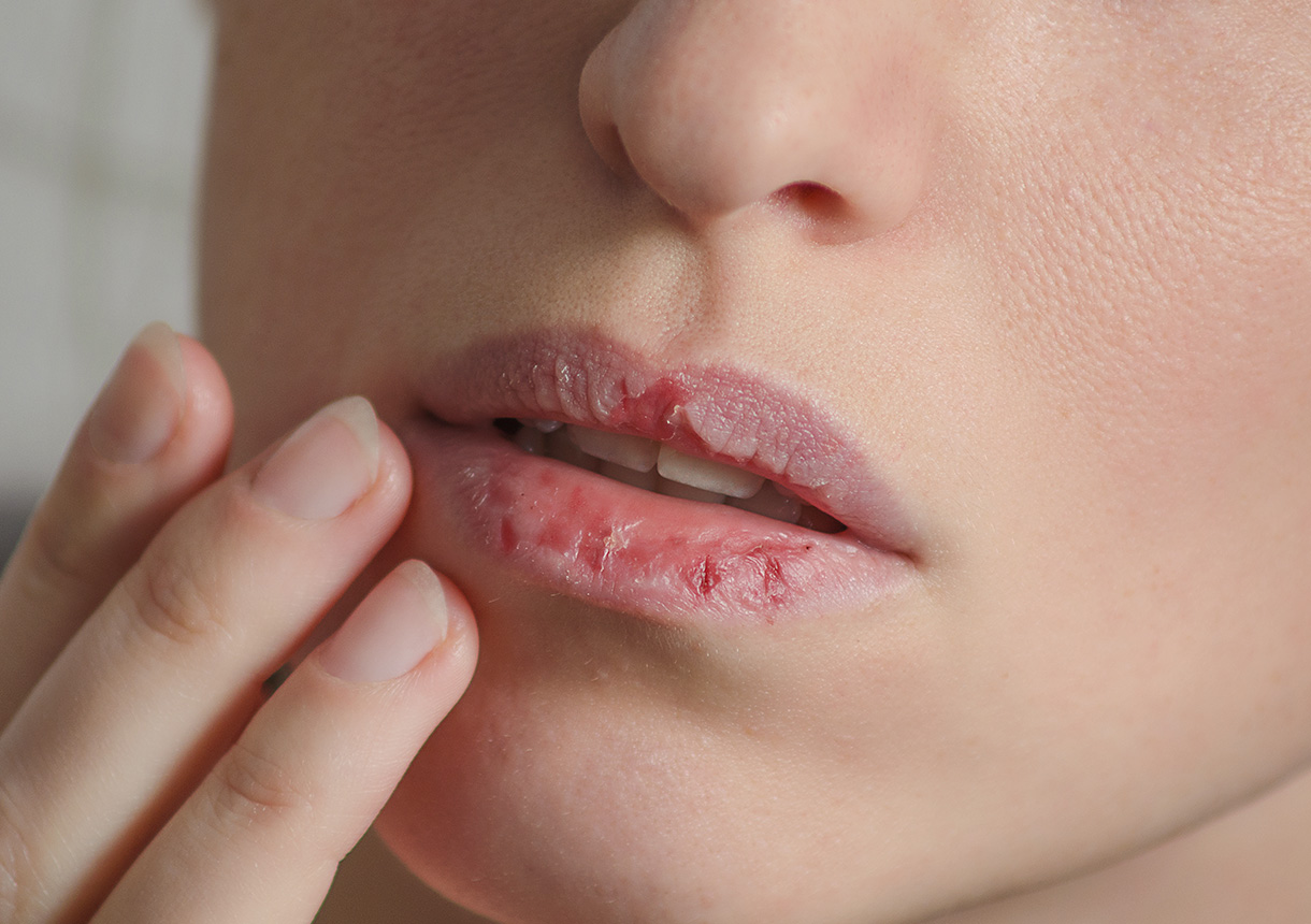 Lippen geschwollene Was hilft