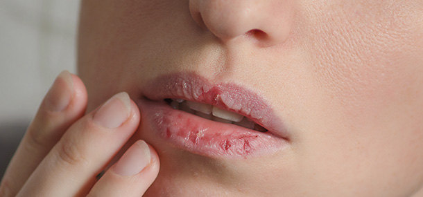 Trockene Lippen – Pflege und Vorbeugung