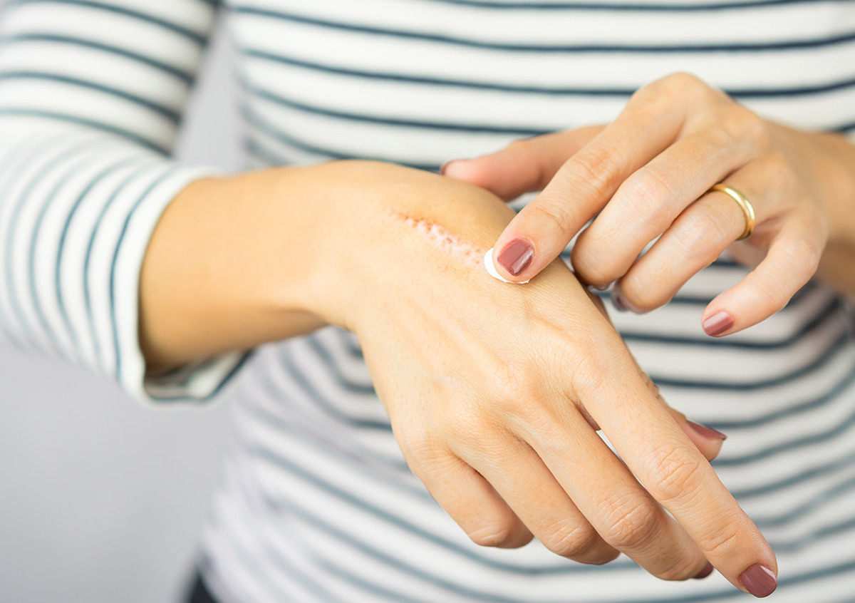 Ausschnitt einer Hand mit Narbe